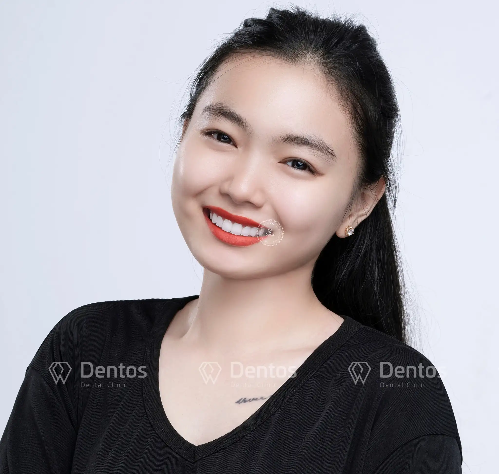 Lựa chọn bọc răng sứ là một khoản đầu tư cho sức khỏe và sự tự tin